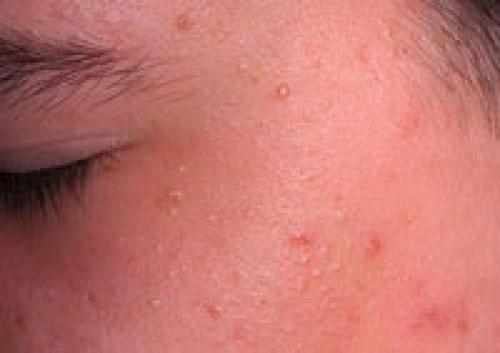 Маски для лица в домашних условиях против черных точек и прыщей. Особенности лечения прыщей в домашних условиях 15 Маски для лица в домашних условиях против черных точек и прыщей. Особенности лечения прыщей в домашних условиях 15