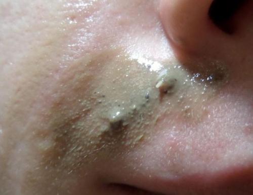 Маски для лица в домашних условиях против черных точек и прыщей. Особенности лечения прыщей в домашних условиях 14 Маски для лица в домашних условиях против черных точек и прыщей. Особенности лечения прыщей в домашних условиях 14