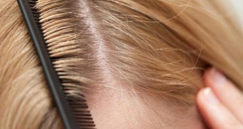 Маска от перхоти с медом. Как в домашних условиях сделать маску для волос от перхоти?