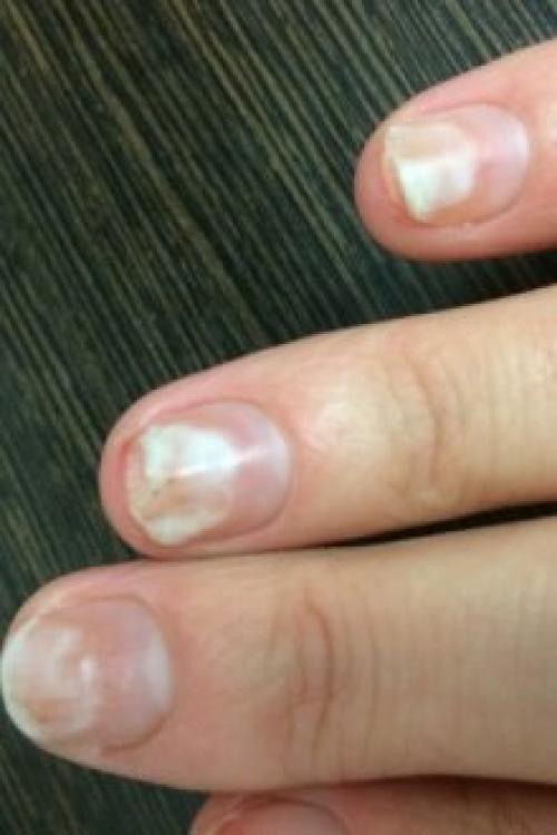 Что делать если отслаивается гель-лак на ногтях. Почему отслаивается гель-лак от ногтей: причины и особенности