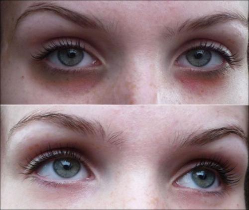 Как убрать возрастные мешки под глазами. Как быстро убрать или замаскировать мешки под глазами