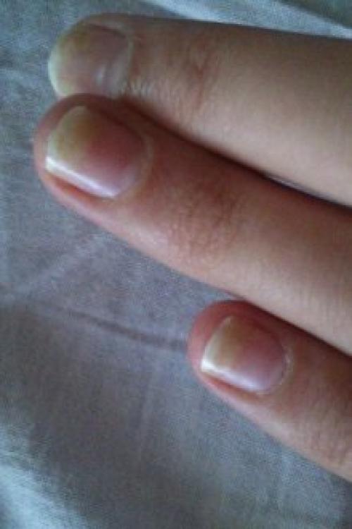 Почему гель-лак слезает пленкой. Почему отслаивается гель-лак от ногтей: причины и особенности