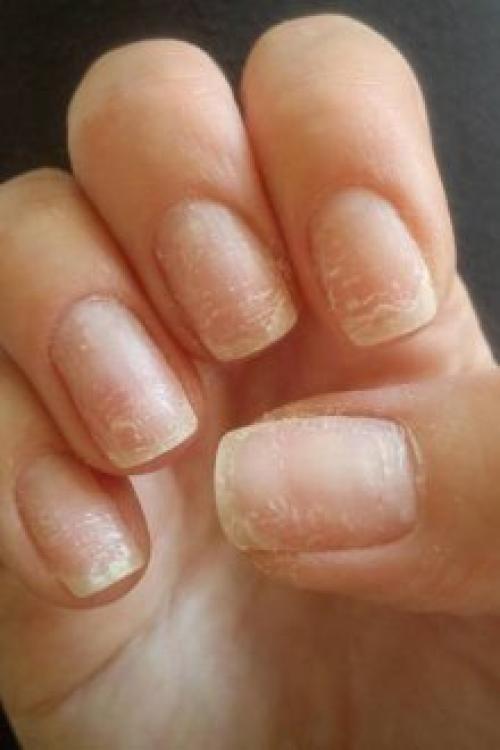 Почему гель-лак слезает пленкой. Почему отслаивается гель-лак от ногтей: причины и особенности