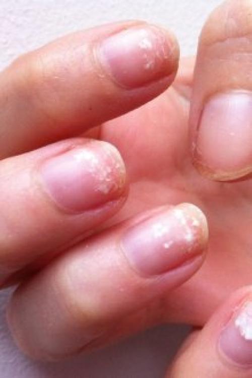 Почему гель-лак слезает пленкой. Почему отслаивается гель-лак от ногтей: причины и особенности