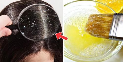 Что помогает против перхоти. Домашние маски для головы от перхоти