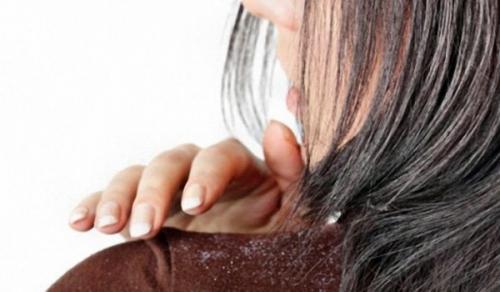 Маска против перхоти. Рецепты масок от перхоти 08