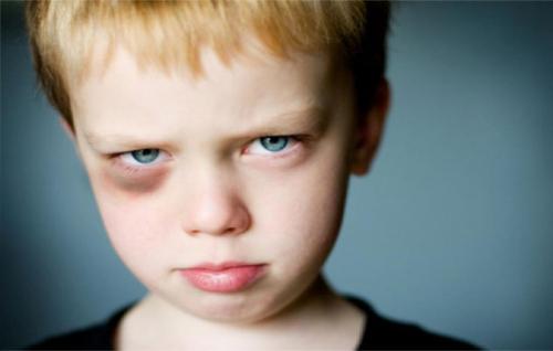 Как избавиться от синяков под глазами от удара. Как быстро убрать (свести) синяк под глазом от удара и чем лечить гематому нижнего века