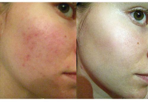 Black mask в домашних условиях. Рецепт Блэк маск. Пошаговое нанесение в домашних условиях 18