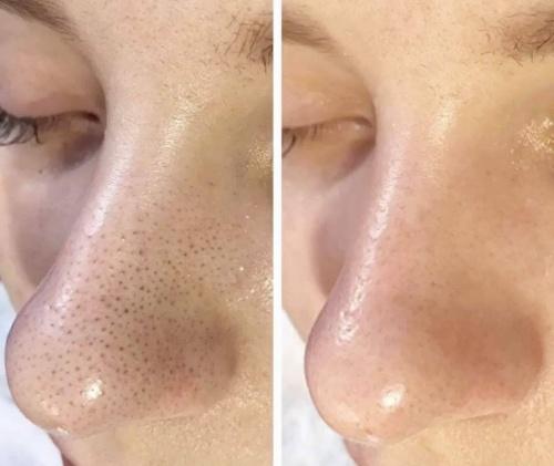 Маска от черных точек в домашних условиях без желатина. Маски от черных точек в домашних условиях