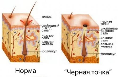 Маски от черных точек в домашних условиях для подростков без желатина. Причины появления черных точек на лице