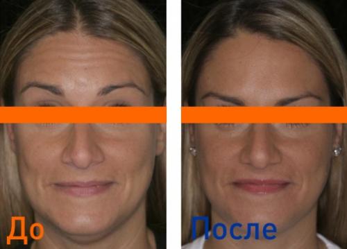 Уколы красоты препараты. Что такое уколы красоты и их разновидности