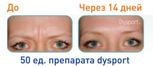 Уколы красоты препараты. Что такое уколы красоты и их разновидности