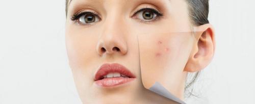 Уколы в лицо от прыщей. Мезотерапия при акне