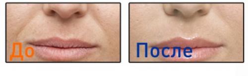 Уколы красоты препараты. Что такое уколы красоты и их разновидности