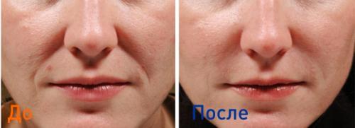 Уколы красоты препараты. Что такое уколы красоты и их разновидности