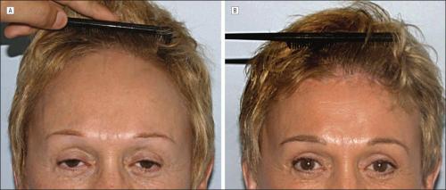 Челка на Большой лоб: что это такое и как с этим жить 03