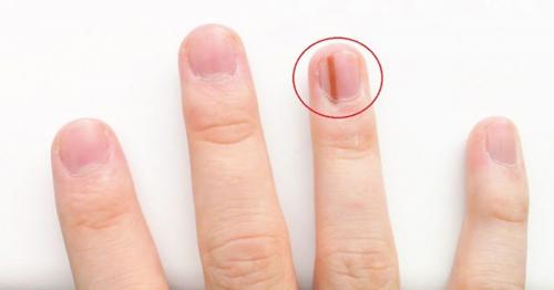 Отслойки на ногтях, что это. Что такое ониходистрофия