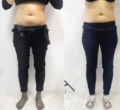 Коррекция фигуры липолитиками. 01