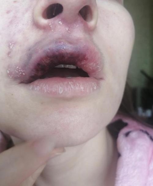 Я сделала губы у косметолога 3 дня назад, и к вечеру у меня появились пятна на лице с правой стороны губы, переходящие на нос и лоб.

