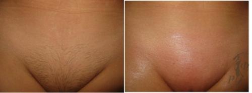 Крем для депиляции Fito Depilation (фито депилейшен? 03 Крем для депиляции Fito Depilation (фито депилейшен? 03